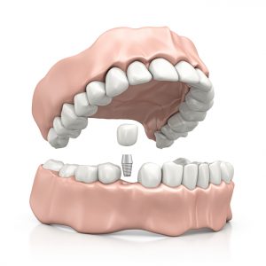 Learn about the surgery for dental implants in Boca Raton.