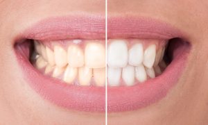 cosmetic dentist in boca raton