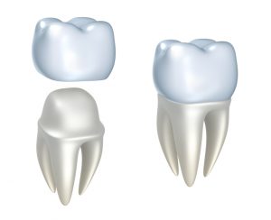 High-quality dental crowns in Boca Raton.